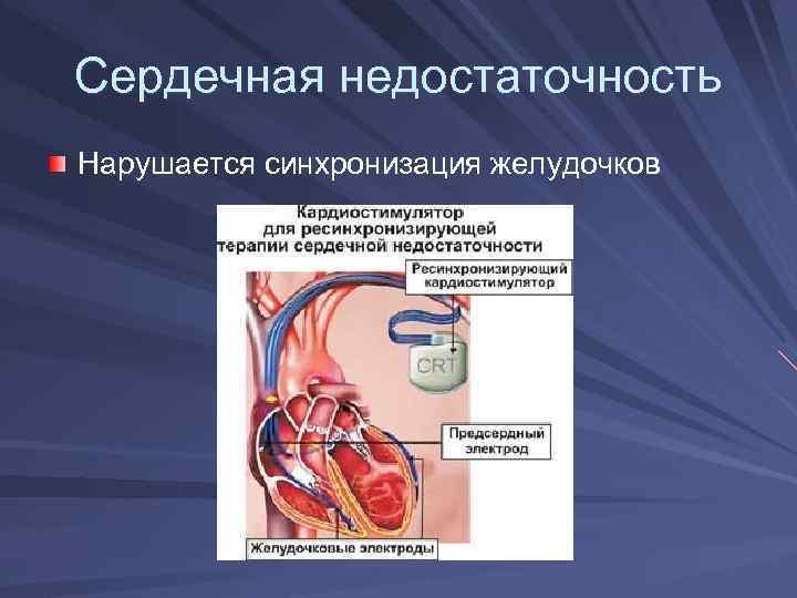 Сердечная недостаточность Нарушается синхронизация желудочков 
