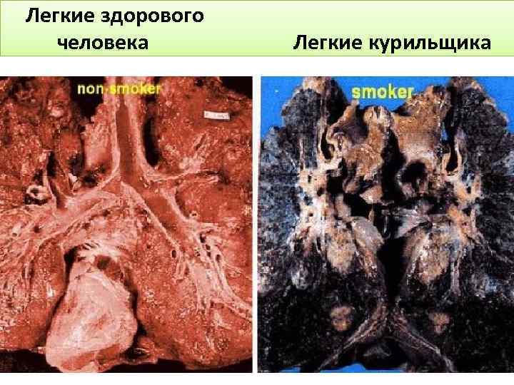 Легкие здорового человека Легкие курильщика 