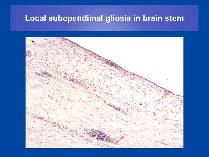 Local subependimal gliosis in brain stem 