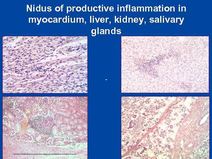Nidus of productive inflammation in myocardium, liver, kidney, salivary glands 