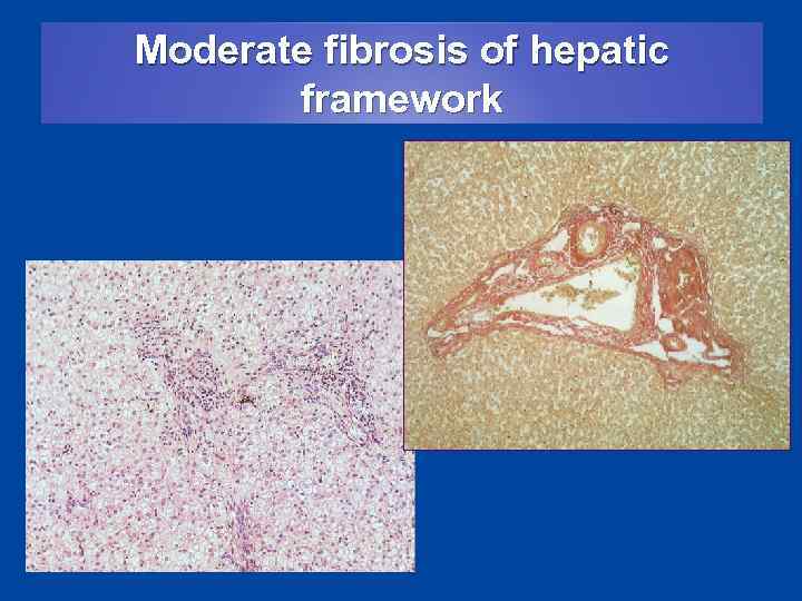 Moderate fibrosis of hepatic framework 