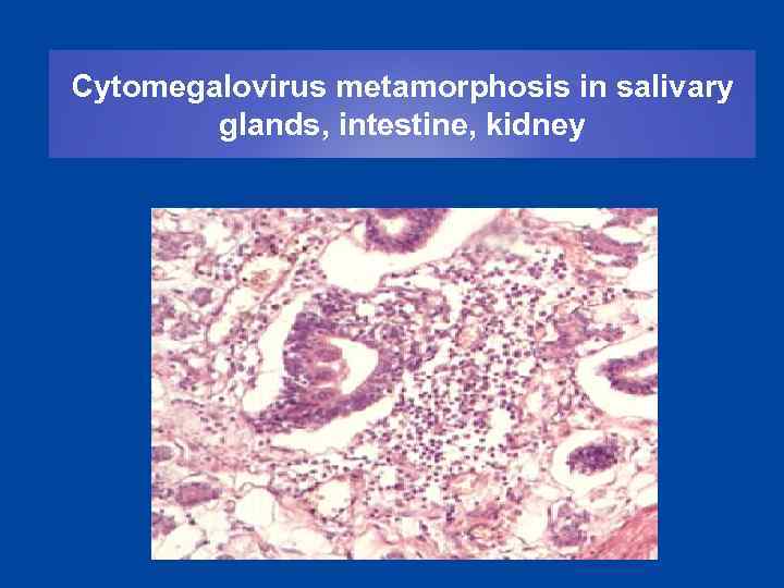 Cytomegalovirus metamorphosis in salivary glands, intestine, kidney 