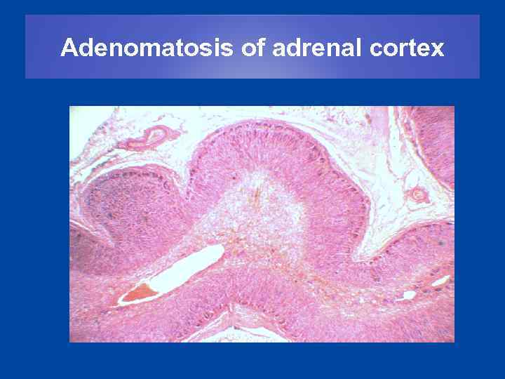 Adenomatosis of adrenal cortex 