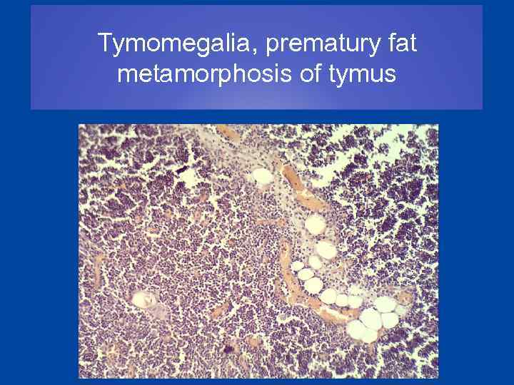 Tymomegalia, prematury fat metamorphosis of tymus 