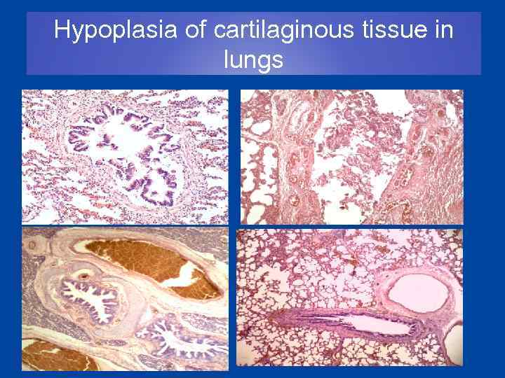 Hypoplasia of cartilaginous tissue in lungs 