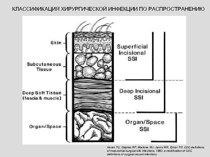 КЛАССИФИКАЦИЯ ХИРУРГИЧЕСКОЙ ИНФЕКЦИИ ПО РАСПРОСТРАНЕНИЮ Horan TC, Gaynes RP, Martone WJ, Jarvis WR, Emori