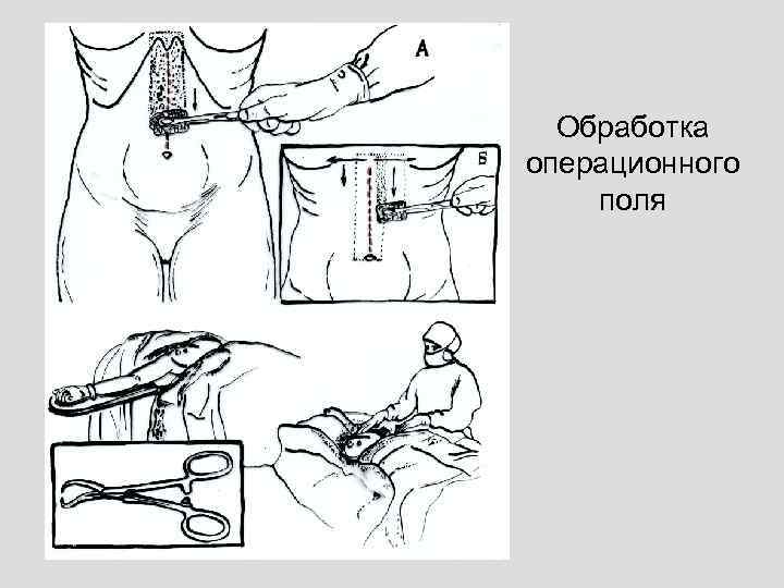Обработка операционного поля 