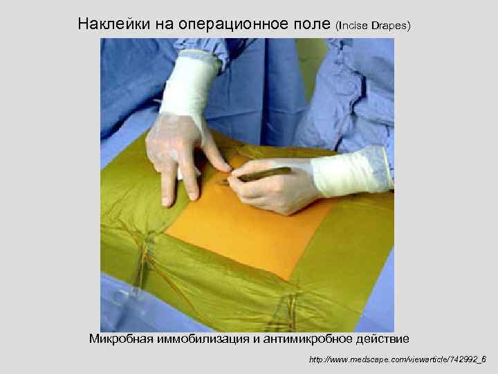 Наклейки на операционное поле (Incise Drapes) Микробная иммобилизация и антимикробное действие http: //www. medscape.