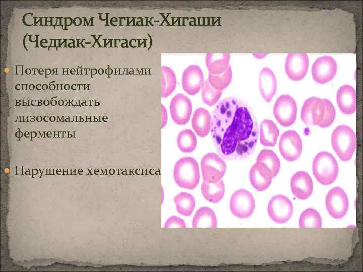 Синдром Чегиак-Хигаши (Чедиак-Хигаси) Потеря нейтрофилами способности высвобождать лизосомальные ферменты Нарушение хемотаксиса 