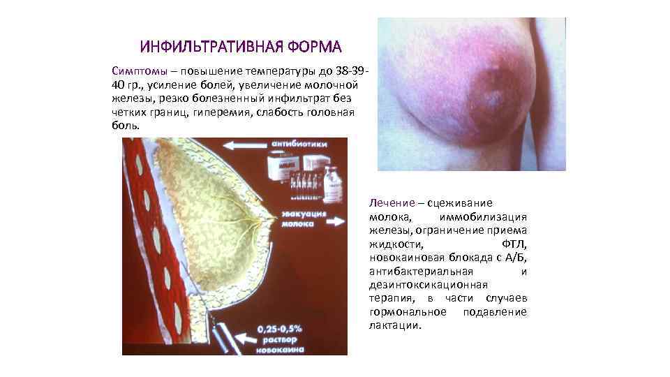ИНФИЛЬТРАТИВНАЯ ФОРМА Симптомы – повышение температуры до 38 -3940 гр. , усиление болей, увеличение