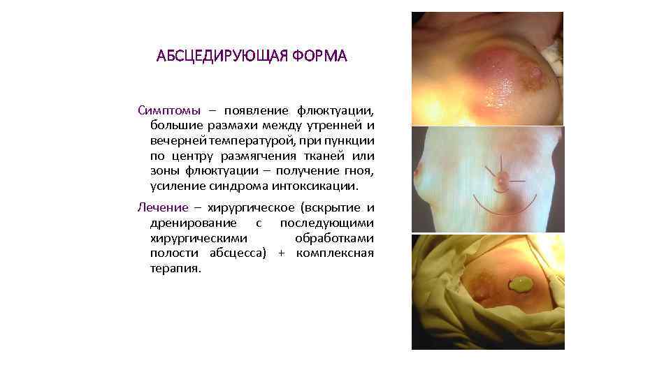 АБСЦЕДИРУЮЩАЯ ФОРМА Симптомы – появление флюктуации, большие размахи между утренней и вечерней температурой, при