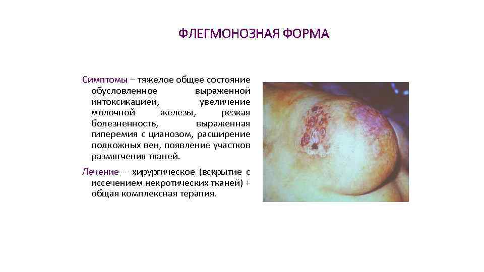 ФЛЕГМОНОЗНАЯ ФОРМА Симптомы – тяжелое общее состояние обусловленное выраженной интоксикацией, увеличение молочной железы, резкая
