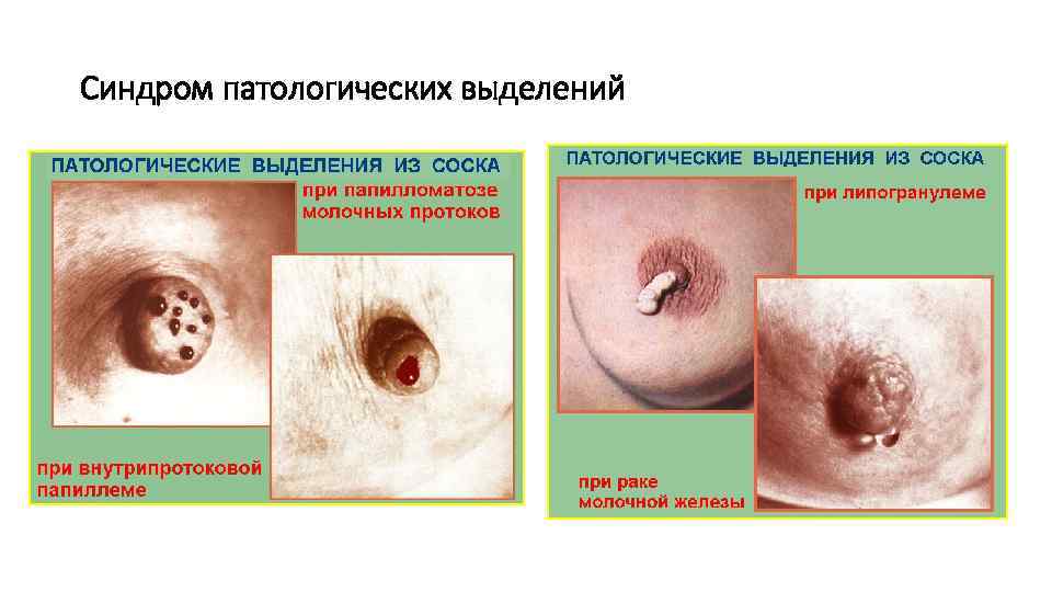 Синдром патологических выделений 