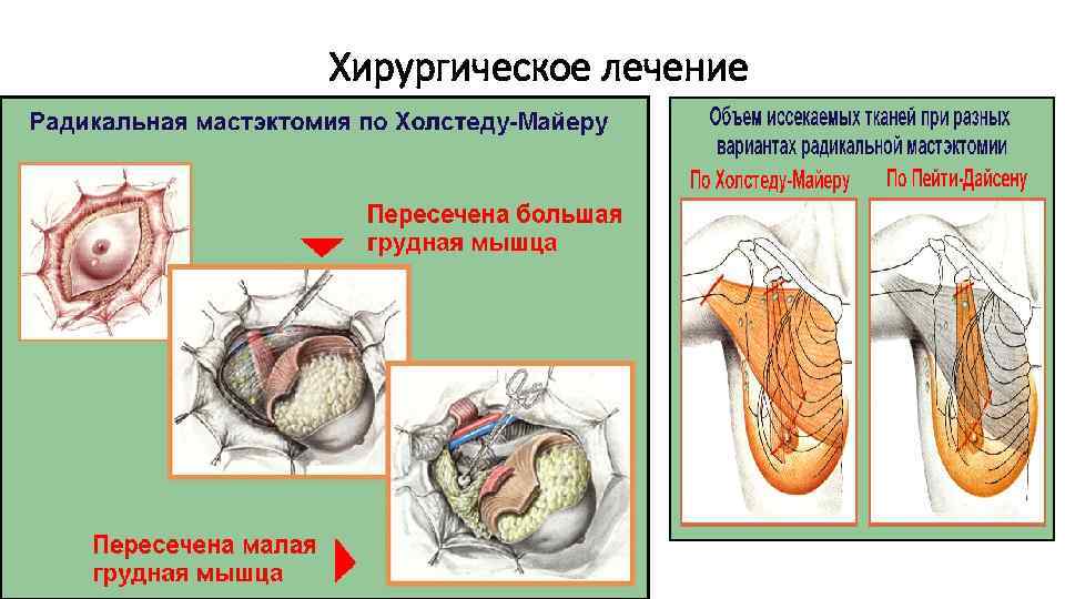 Хирургическое лечение 