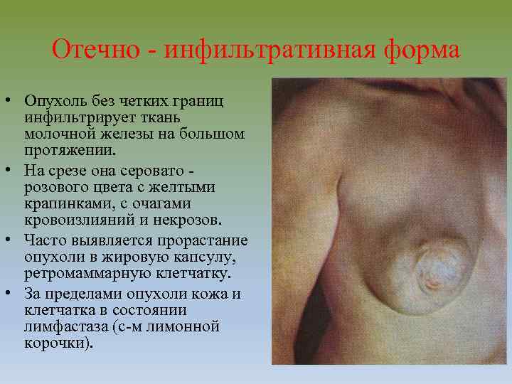 Отечно инфильтративная форма • Опухоль без четких границ инфильтрирует ткань молочной железы на большом