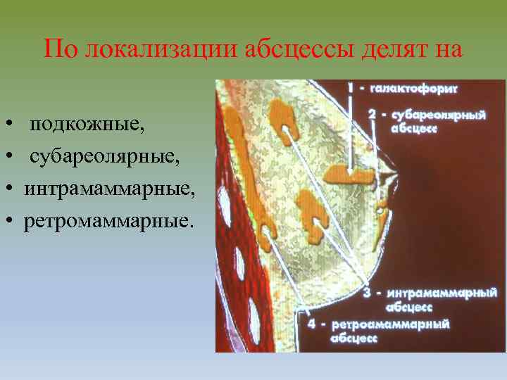 По локализации абсцессы делят на • • подкожные, субареолярные, интрамаммарные, ретромаммарные. 