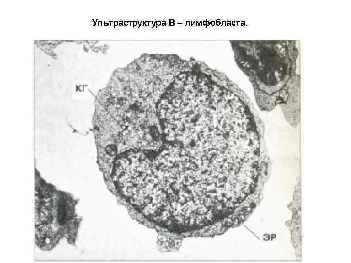 Ультраструктура В – лимфобласта. 