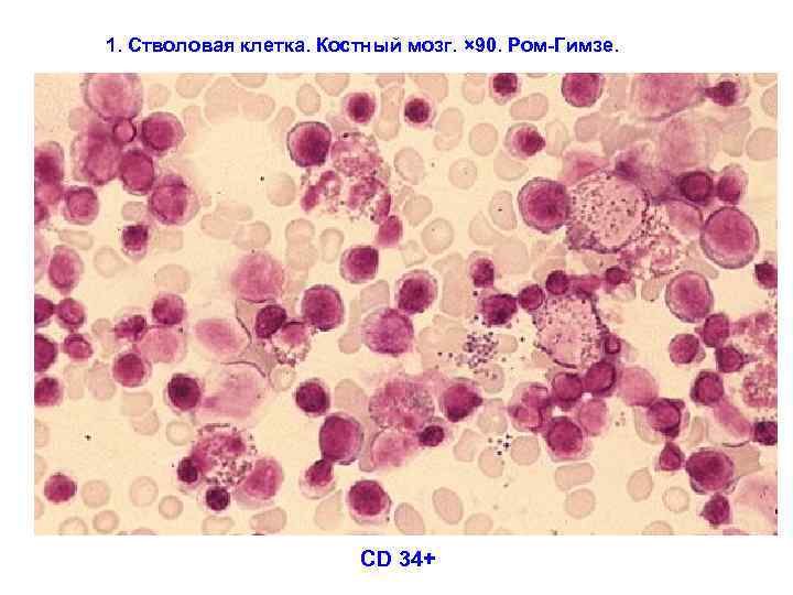 1. Стволовая клетка. Костный мозг. × 90. Ром-Гимзе. CD 34+ 