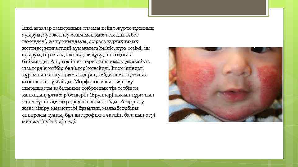 Ішкі ағзалар тамырының спазмы кейде жүрек тұсының ауыруы, ауа жетпеу сезімімен қабаттасады тәбет төмендеуі,