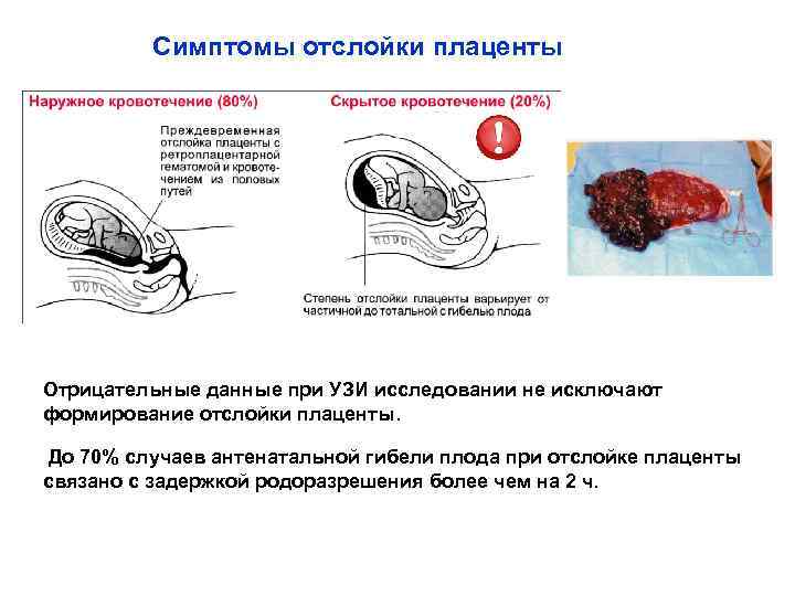 Симптомы отслойки плаценты Отрицательные данные при УЗИ исследовании не исключают формирование отслойки плаценты. До