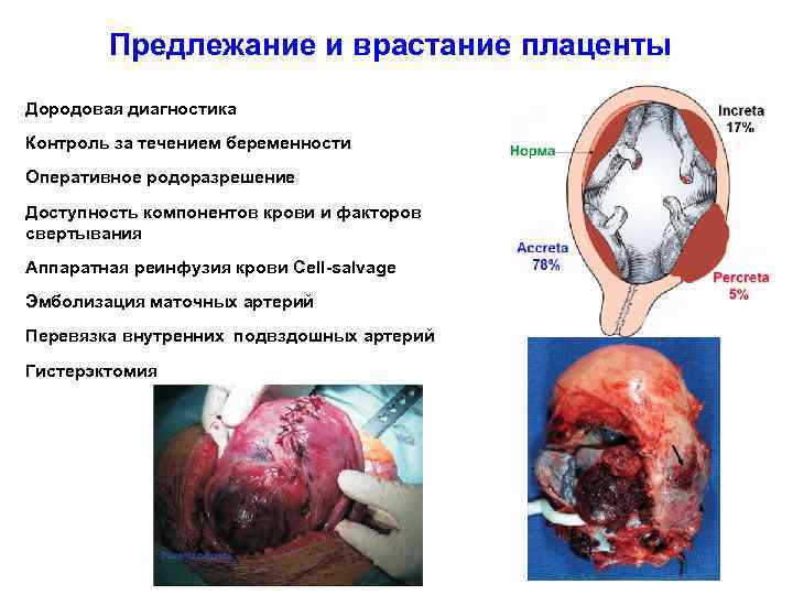 Предлежание и врастание плаценты Дородовая диагностика Контроль за течением беременности Оперативное родоразрешение Доступность компонентов