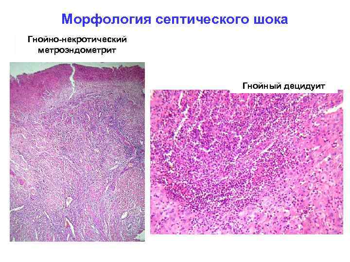 Морфология септического шока Гнойно-некротический метроэндометрит Гнойный децидуит 