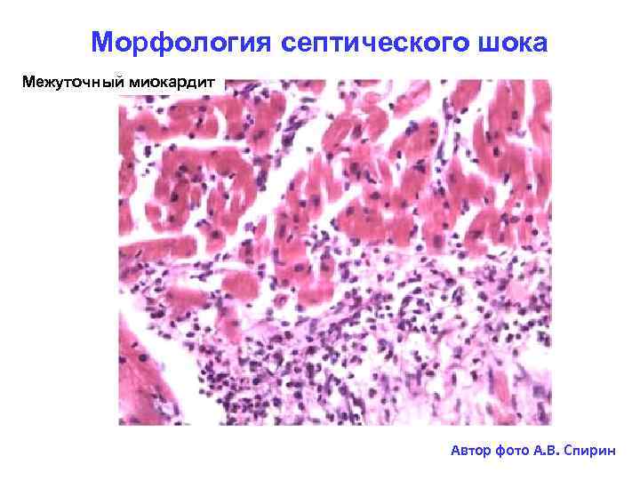 Морфология септического шока Межуточный миокардит Автор фото А. В. Спирин 