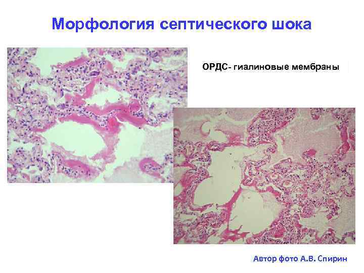 Морфология септического шока ОРДС- гиалиновые мембраны Автор фото А. В. Спирин 
