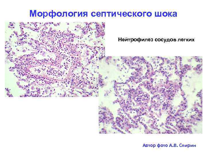 Морфология септического шока Нейтрофилез сосудов легких Автор фото А. В. Спирин 
