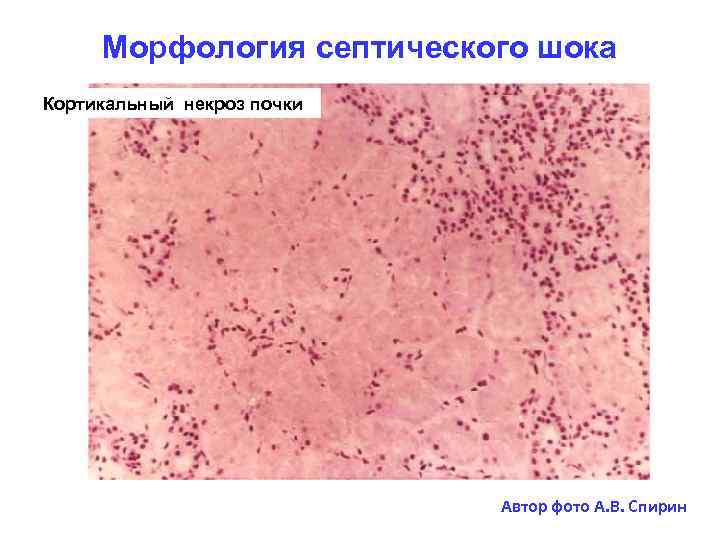 Морфология септического шока Кортикальный некроз почки Автор фото А. В. Спирин 