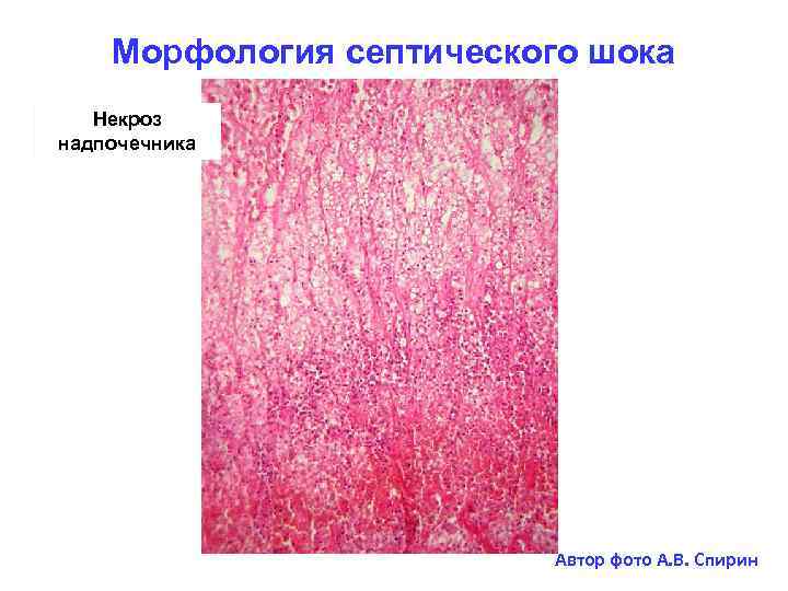 Морфология септического шока Некроз надпочечника Автор фото А. В. Спирин 