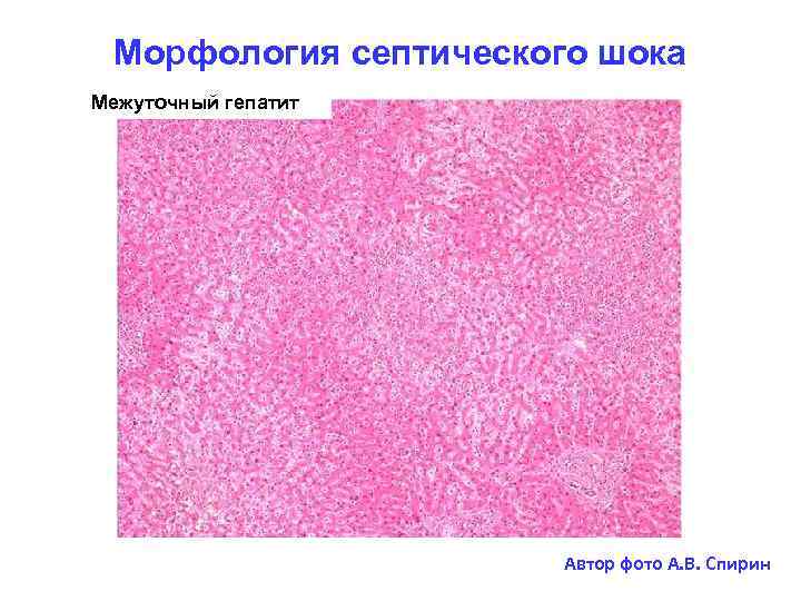 Морфология септического шока Межуточный гепатит Автор фото А. В. Спирин 