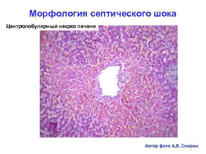 Морфология септического шока Центролобулярный некроз печени Автор фото А. В. Спирин 