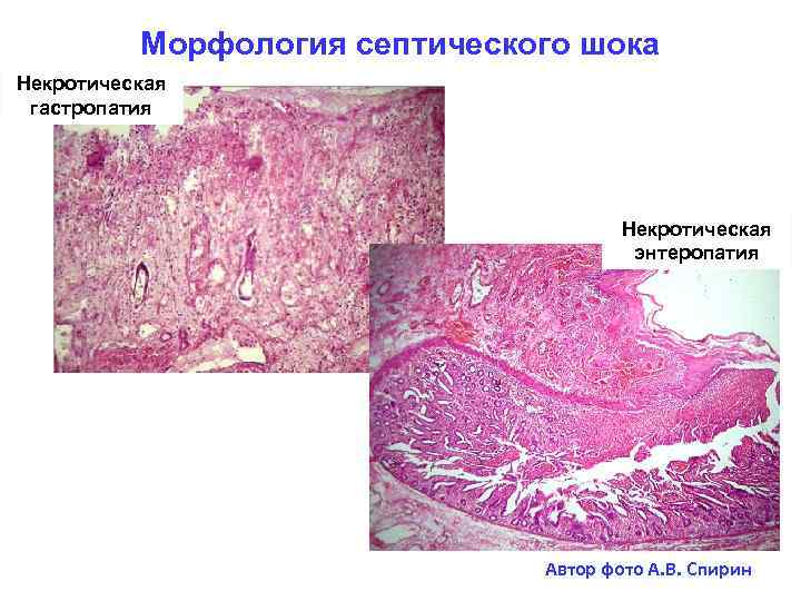 Морфология септического шока Некротическая гастропатия Некротическая энтеропатия Автор фото А. В. Спирин 