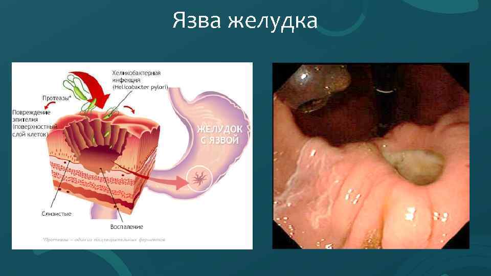 Язва желудка 