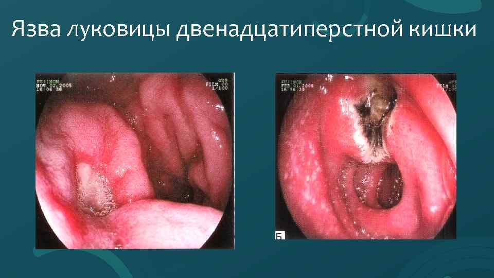 Язва луковицы двенадцатиперстной кишки 