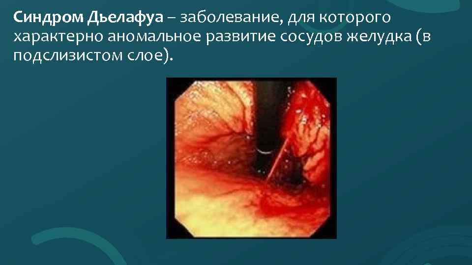 Синдром Дьелафуа – заболевание, для которого характерно аномальное развитие сосудов желудка (в подслизистом слое).