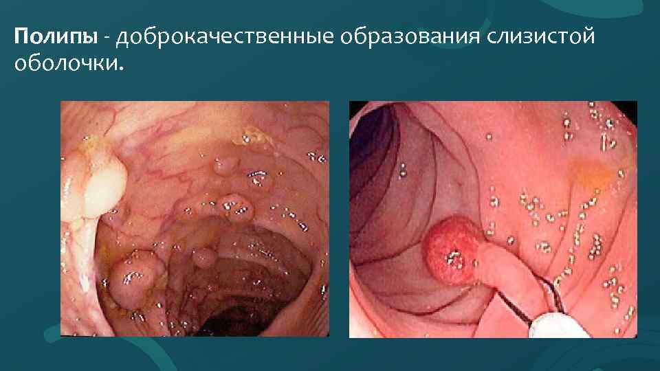 Полипы - доброкачественные образования слизистой оболочки. 