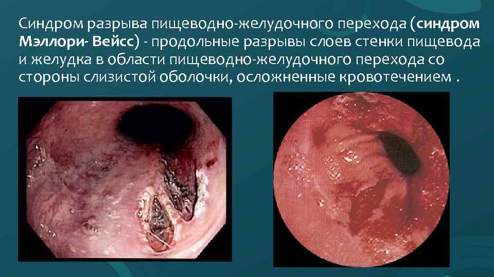 Синдром разрыва пищеводно-желудочного перехода (синдром Мэллори- Вейсс) - продольные разрывы слоев стенки пищевода и