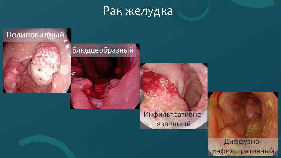 Рак желудка 