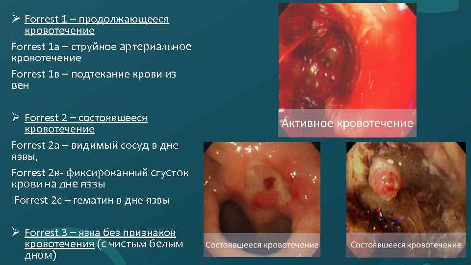 Ø Forrest 1 – продолжающееся кровотечение Forrest 1 а – струйное артериальное кровотечение Forrest