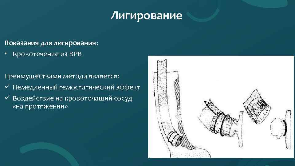 Лигирование Показания для лигирования: • Кровотечение из ВРВ Преимуществами метода является: ü Немедленный гемостатический