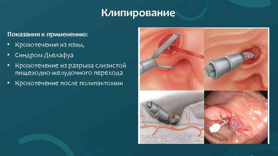 Клипирование Показания к применению: • Кровотечения из язвы, • Синдром Дьелафуа • Кровотечение из