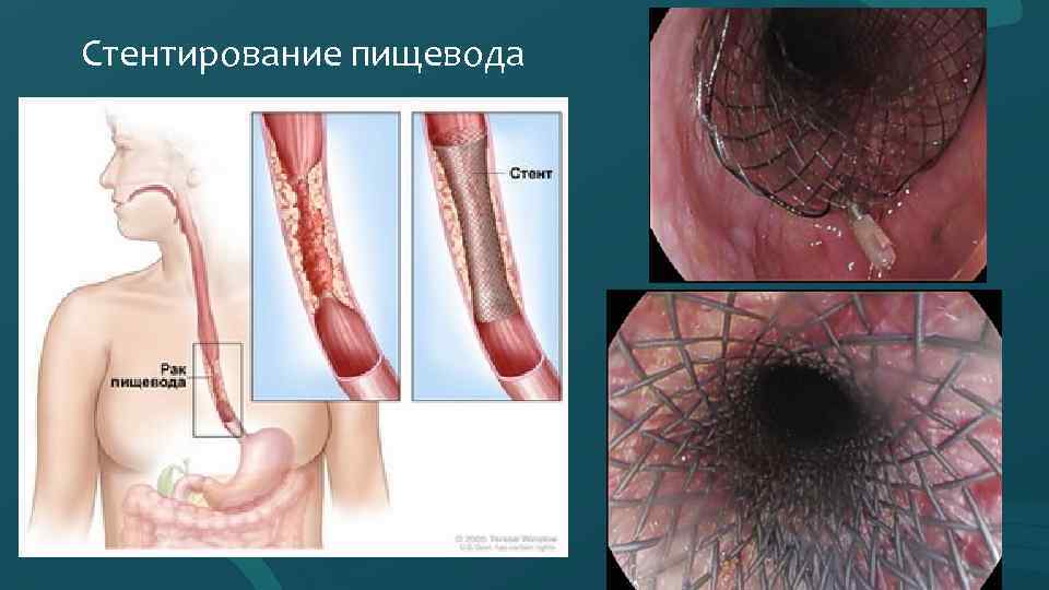Стентирование пищевода 