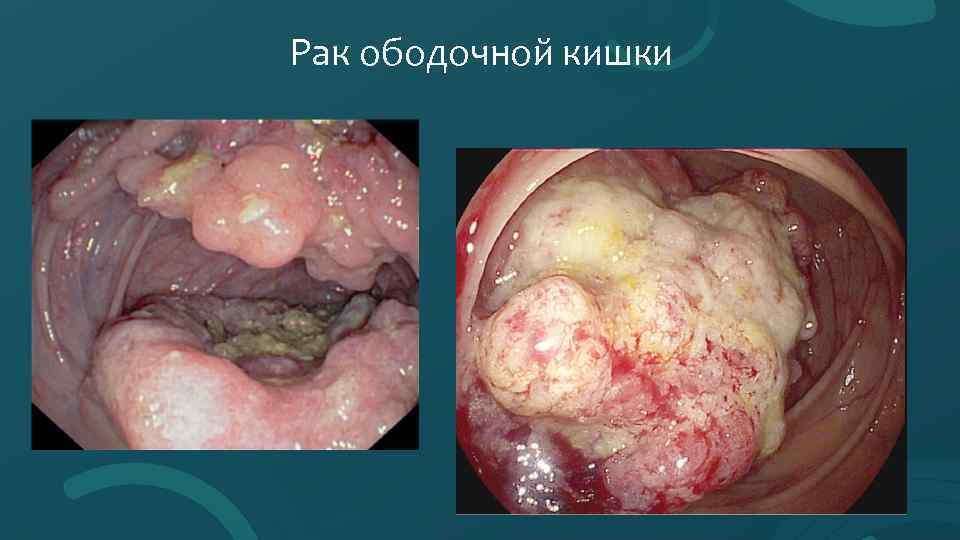 Рак ободочной кишки 