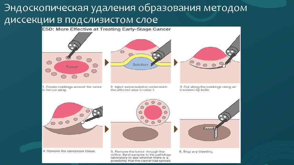 Эндоскопическая удаления образования методом диссекции в подслизистом слое 