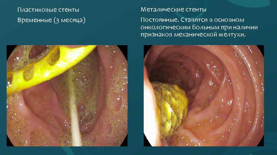 Пластиковые стенты Временные (3 месяца) Металические стенты Постоянные. Ставятся в основном онкологическим больным при