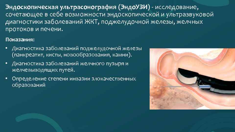 Эндоскопическая ультрасонография (Эндо. УЗИ) - исследование, сочетающее в себе возможности эндоскопической и ультразвуковой диагностики