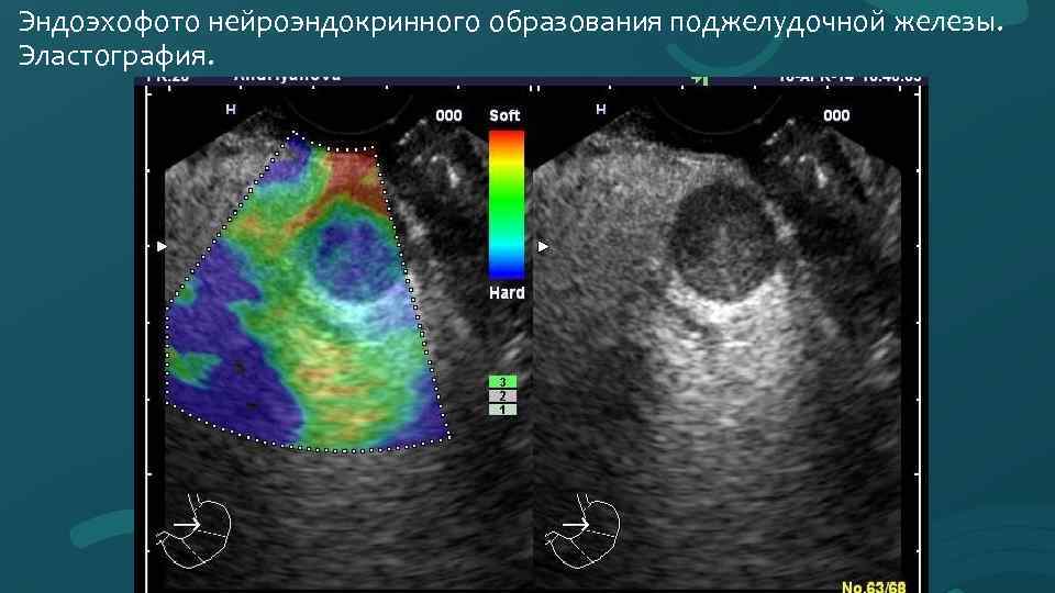 Эндоэхофото нейроэндокринного образования поджелудочной железы. Эластография. 