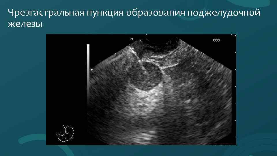 Чрезгастральная пункция образования поджелудочной железы 